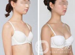 隆胸恢復(fù)期多長(zhǎng)時(shí)間 性感身材輕松擁有