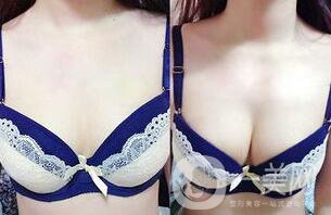隆胸恢復(fù)期多長時(shí)間 性感身材輕松擁有