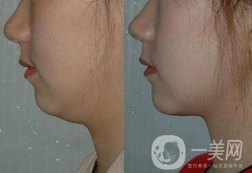雙下巴吸脂注意事項介紹 雙下巴吸脂多少錢