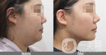 雙下巴吸脂注意事項介紹 雙下巴吸脂多少錢
