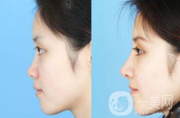 *一個(gè)月定型了嗎？*手術(shù)價(jià)格多少