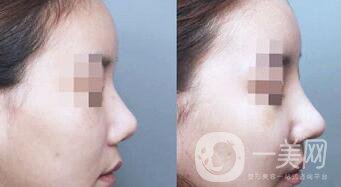 硅膠隆鼻可以管多久 硅膠隆鼻具體費(fèi)用