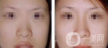 硅膠隆鼻可以管多久 硅膠隆鼻具體費(fèi)用