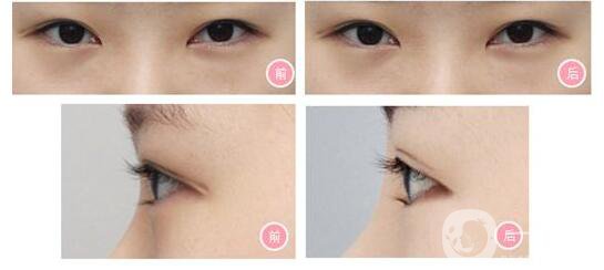 成都開內(nèi)外眼角,開內(nèi)外眼角多少錢,開眼角價(jià)格