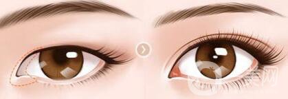 開(kāi)眼角幾天恢復(fù)？開(kāi)眼角手術(shù)費(fèi)用介紹