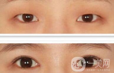 開(kāi)眼角幾天恢復(fù)？開(kāi)眼角手術(shù)費(fèi)用介紹