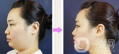 減雙下巴注意事項(xiàng) 減雙下巴手術(shù)價(jià)格多少