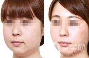 減雙下巴注意事項(xiàng) 減雙下巴手術(shù)價(jià)格多少