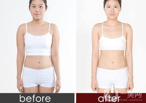 腰腹吸脂,腰腹吸脂多久消腫,腰腹吸脂術后護理方式