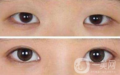 割雙眼皮,北京割雙眼皮,割雙眼皮介紹