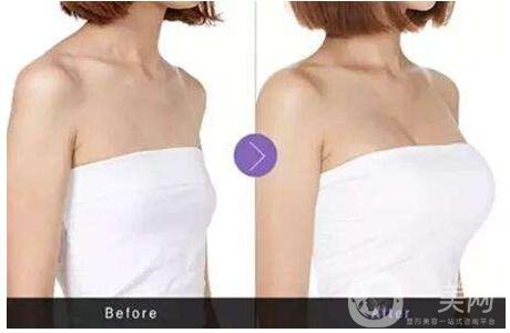 隆胸手術(shù)選擇自體隆胸好還是假體好 2