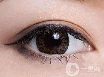 全切雙眼皮做寬了怎么辦