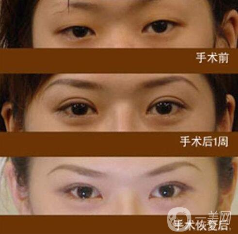 全切雙眼皮做寬了怎么辦