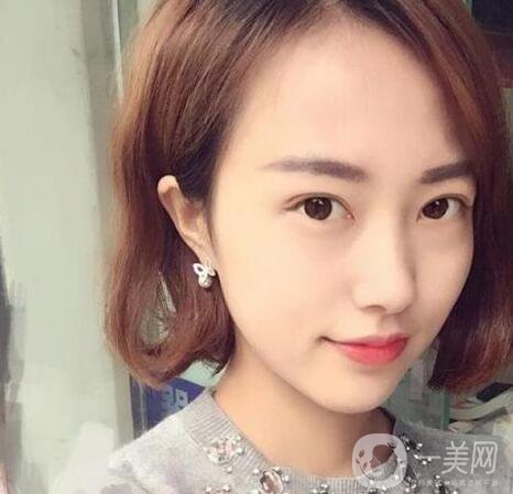 雙眼皮手術(shù)拆線后要怎樣護理 1