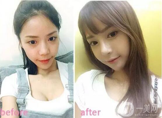 雙眼皮手術(shù)拆線后要怎樣護理 2