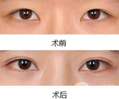 雙眼皮增生了怎么處理？雙眼皮修復(fù)價(jià)格多少