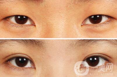 雙眼皮增生了怎么處理？雙眼皮修復(fù)價(jià)格多少