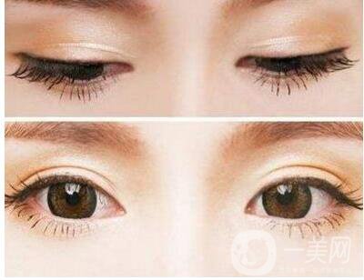 割雙眼皮,割雙眼皮恢復(fù)時間