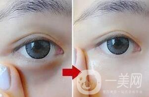 激光去眼袋,激光去眼袋原理,激光去眼袋*果,激光去眼袋*果保持多久