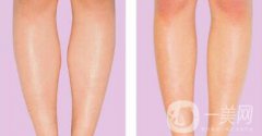 吸脂瘦小腿的危害具體有哪些