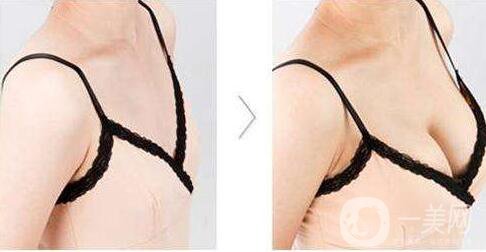 隆胸,隆胸術后護理