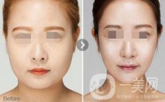 面部吸脂術(shù)后護理怎么做