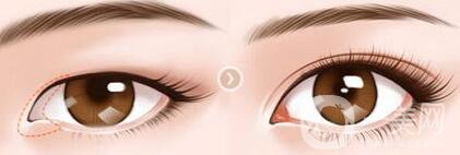 開眼角術(shù)后注意事項具體有哪些