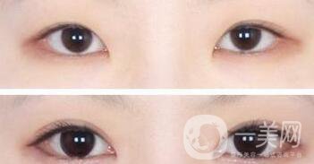 開眼角術(shù)后注意事項具體有哪些