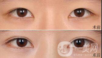 全切雙眼皮怎么護(hù)理 漂亮雙眼的秘密