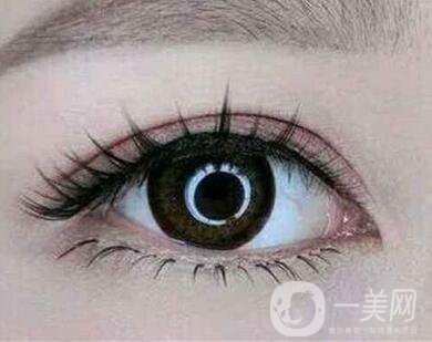 雙眼皮埋線前注意什么？