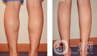 光纖溶脂瘦小腿*果到底怎么樣