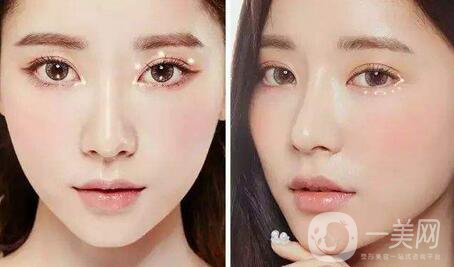 雙眼皮拆線后怎么護(hù)理？