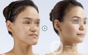 北京頜骨矯正手術(shù)多少錢(qián)