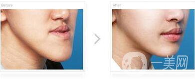 北京頜骨矯正手術(shù)多少錢(qián)