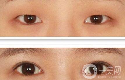 北京做開眼角手術(shù)多少錢