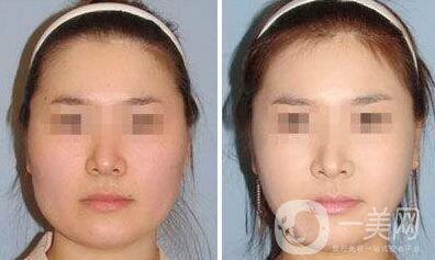 去頰脂墊瘦臉術后護理怎么做？