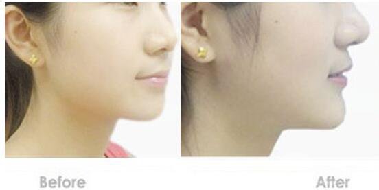 硅膠墊下巴,硅膠墊下巴多少錢,廣州硅膠墊下巴多少錢