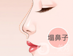 假體隆鼻手術(shù)之后多久可以修復(fù)