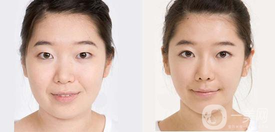 激光溶脂瘦臉多久見(jiàn)*