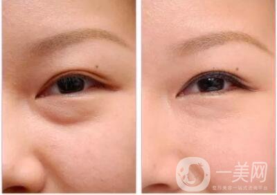 超聲波祛眼袋術(shù)前準(zhǔn)備事項(xiàng)