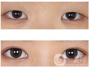 開(kāi)眼角后注意事項(xiàng)主要有哪些