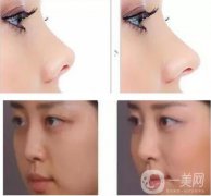 鼻小柱延長恢復過程是怎樣的