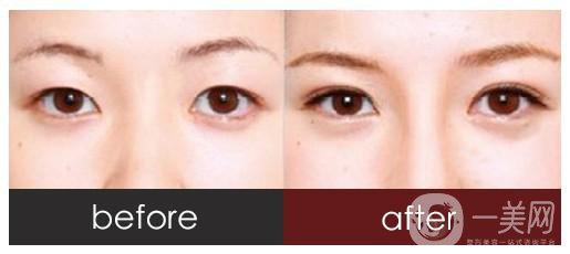 做全切雙眼皮術前準備工作有哪些