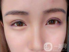 全切雙眼皮手術疼嗎