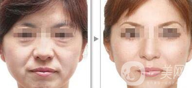 電波拉皮除皺好嗎？*果到底怎么樣