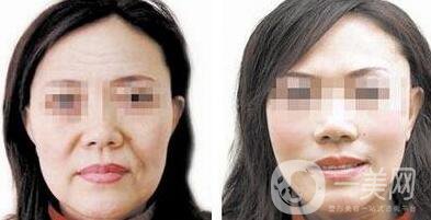 電波拉皮除皺好嗎？*果到底怎么樣