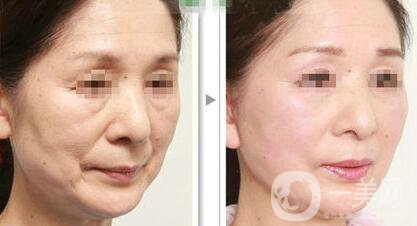 廈門做電波拉皮除皺多少錢