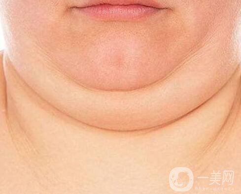 去雙下巴,去雙下巴方法