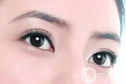 割雙眼皮痕跡多久消失？