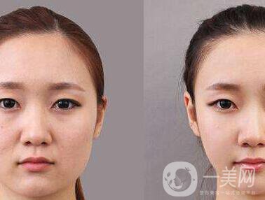 顴骨手術(shù)多長(zhǎng)時(shí)間恢復(fù)？